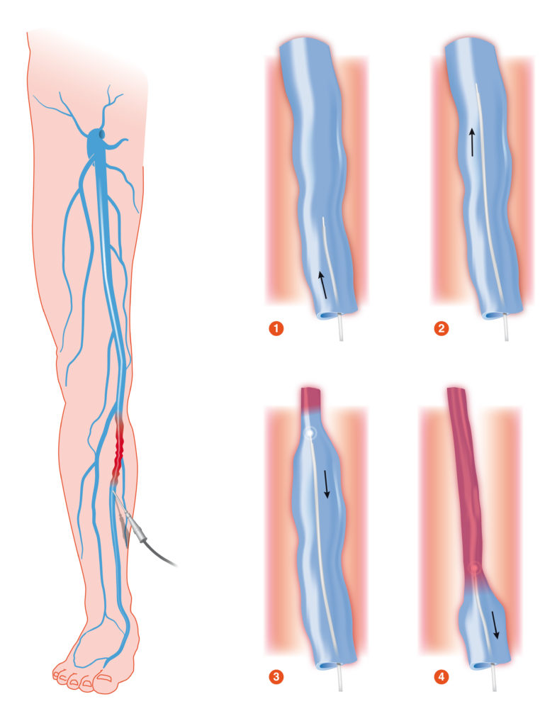 Laser ablation right leg